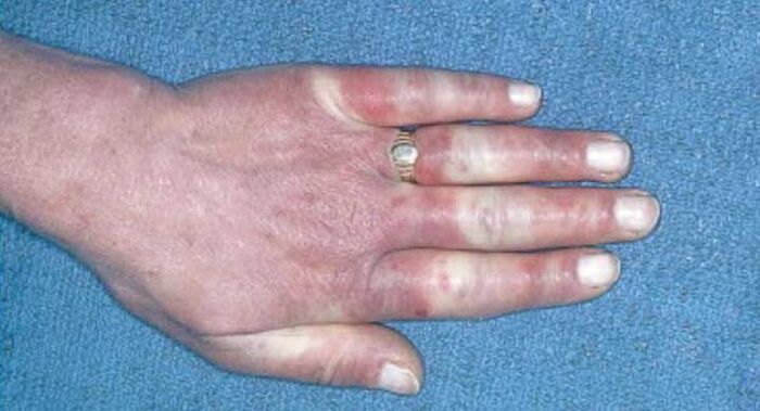 Klinikinis Raynaud sindromo vaizdas – vazospazmas, hiperemija, edema